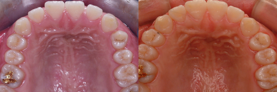 교정-윗니, 아랫니 사이가 벌어진 경우2.jpg