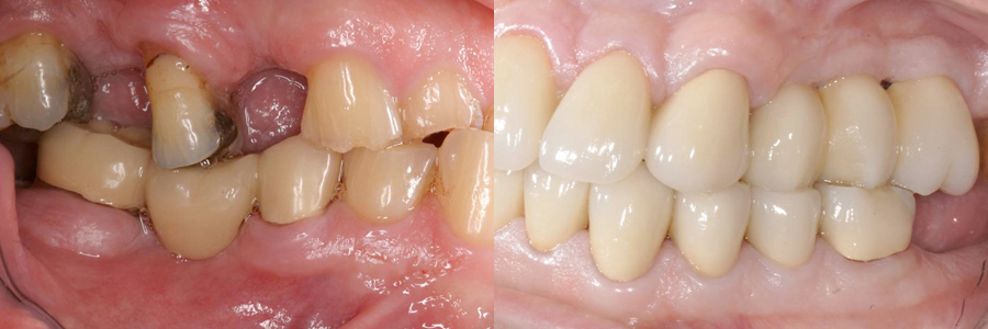 어금니 임플란트, 앞니 완전 도재 금관 수복 후 5년 경과5.jpg