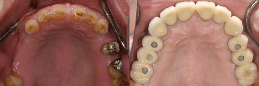 어금니 임플란트, 앞니 완전 도재 금관 수복 후 5년 경과.jpg