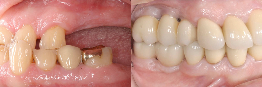 어금니 임플란트, 앞니 완전 도재 금관 수복 후 5년 경과4.jpg