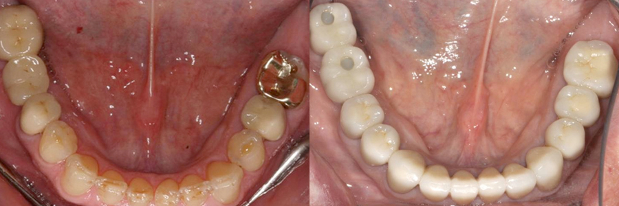 어금니 임플란트, 앞니 완전 도재 금관 수복 후 5년 경과3.jpg