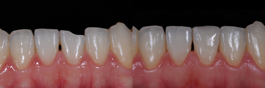 치아가 부러진경우 치아를 삭제하지 않고 치아 모양과 색깔로 형태를 만들어 치아에 붙이는 방법.jpg